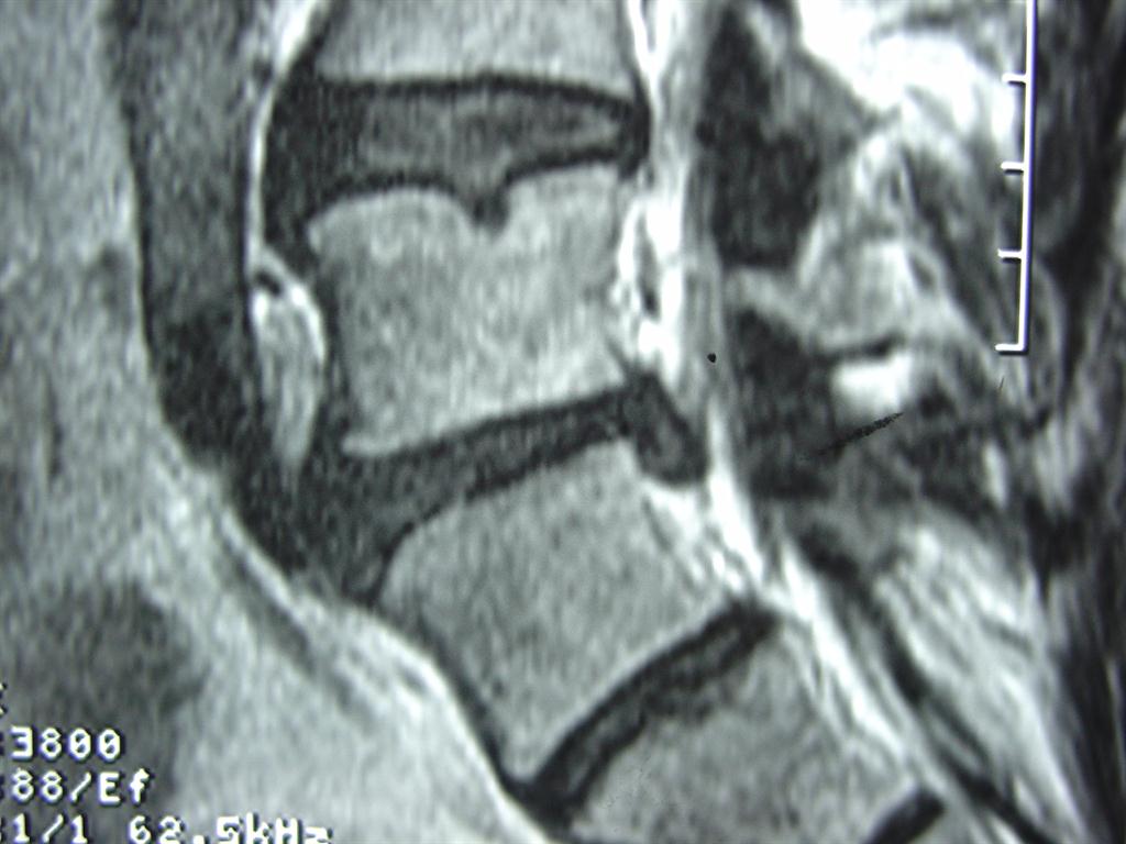 transitional segment with disc herniation